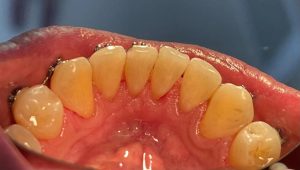 Limpieza Dental