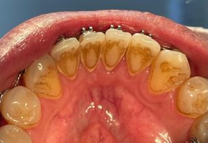 Limpieza Dental