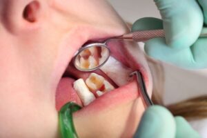 Extraccion dental